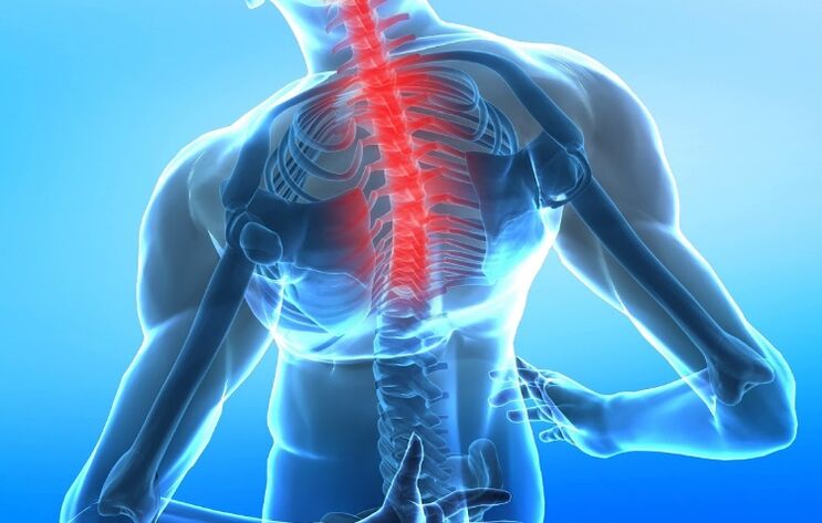 kerusakan pada tulang belakang leher dengan osteochondrosis