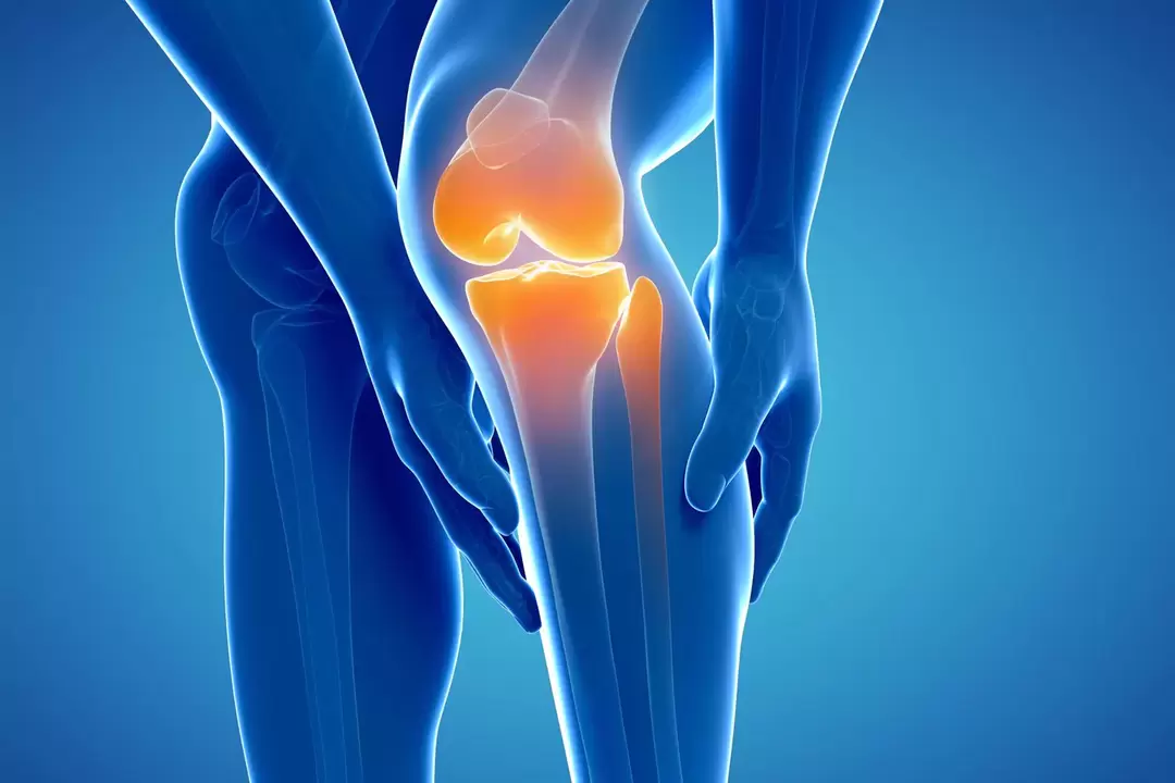 Arthrosis sendi lutut (gonarthrosis, deformasi osteoarthritis)