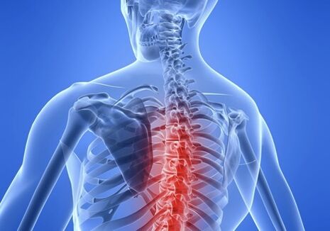 osteochondrosis tulang belakang toraks
