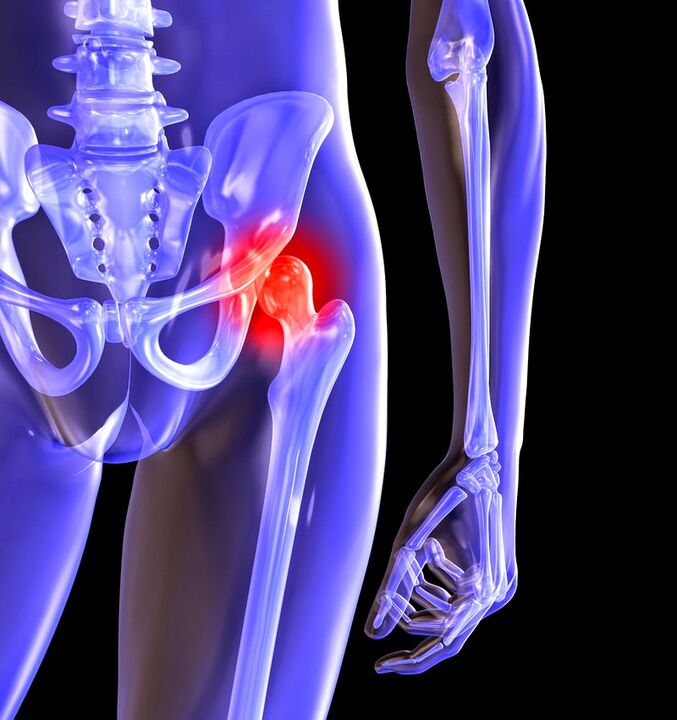 Deforming arthrosis sendi pinggul