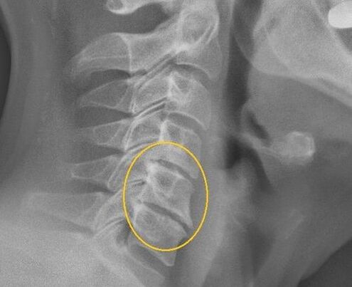 Osteochondrosis tulang belakang leher pada x -ray