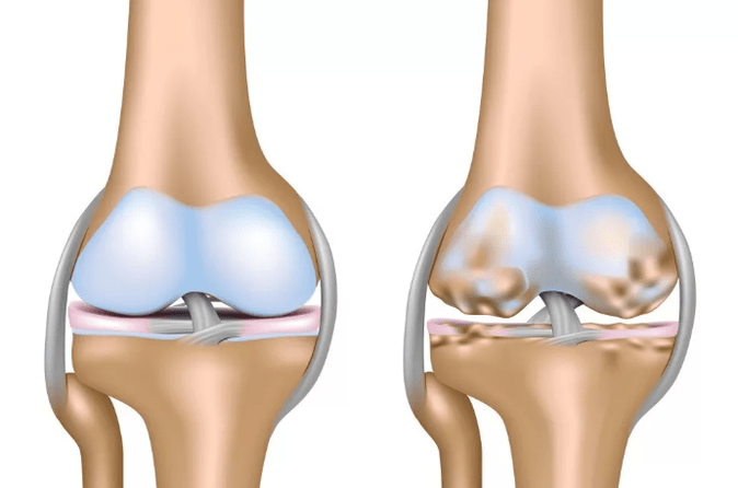 Deforming arthrosis sendi lutut