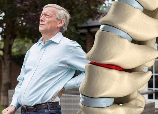 Osteochondrosis mempengaruhi diskus intervertebralis dan menyebabkan nyeri punggung